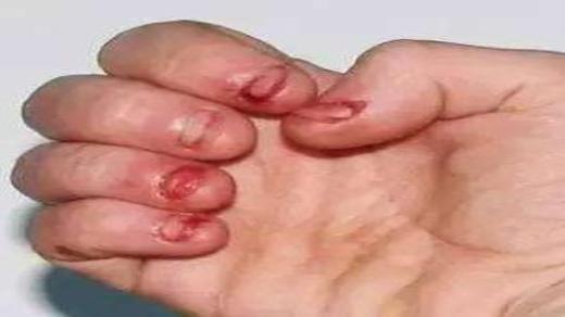 经常啃指甲的危害