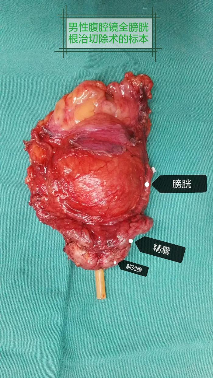 男性和女性膀胱癌全膀胱根治切除术的切除范围 微医（挂号网）