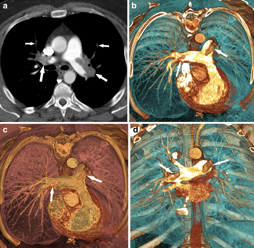 jama一些ct扫描结果可能导致一些肺栓塞患者的过度治疗