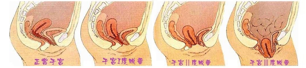 子宫脱垂患者招募