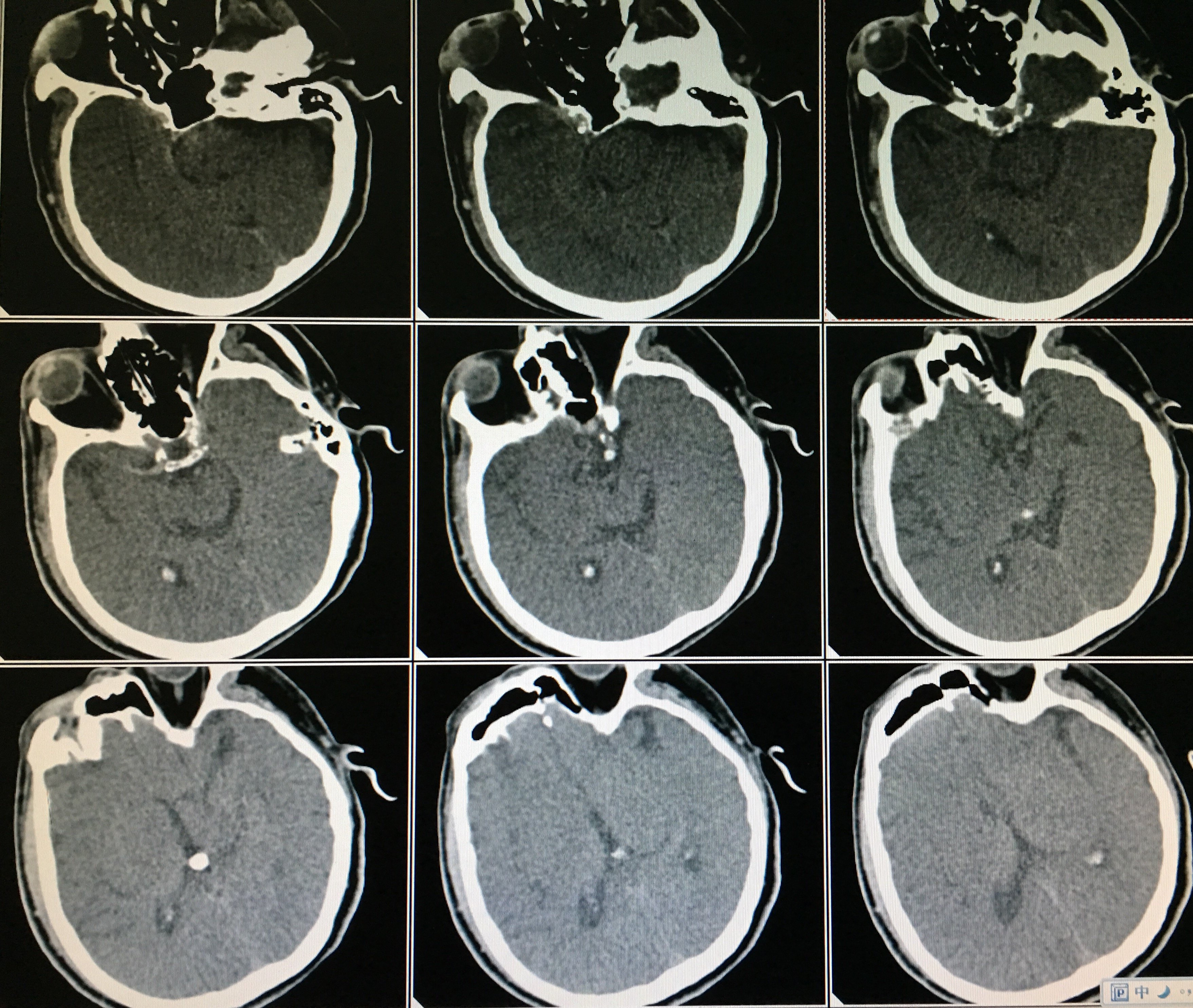 脑动脉急性栓塞的血管内取栓治疗 - 微医(挂号网)