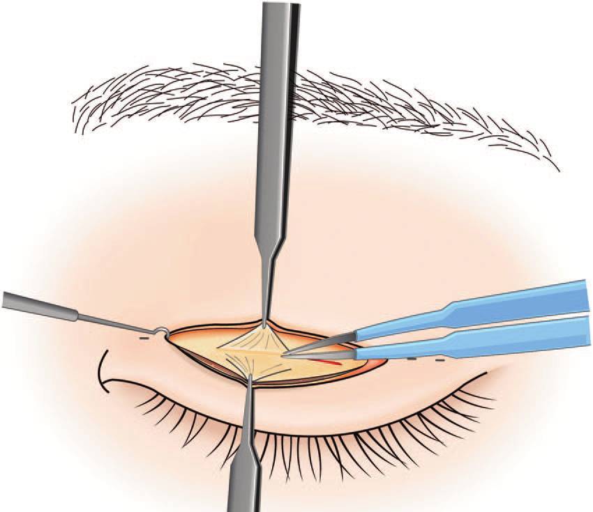 案例图解小切口加埋线双眼皮矫正上睑下垂还你灵动有神双眸