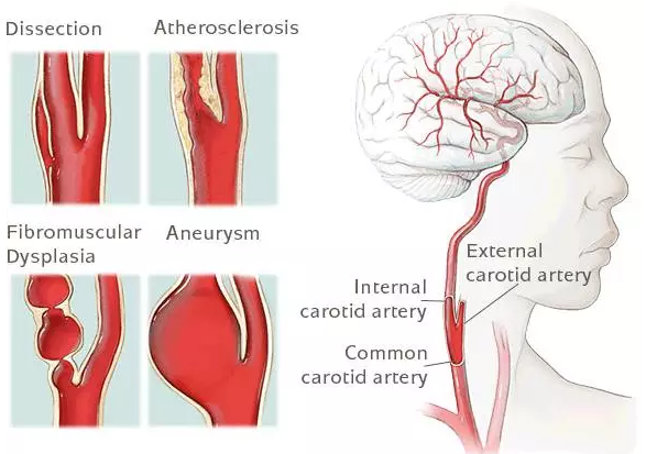 颈动脉狭窄都需要支架吗