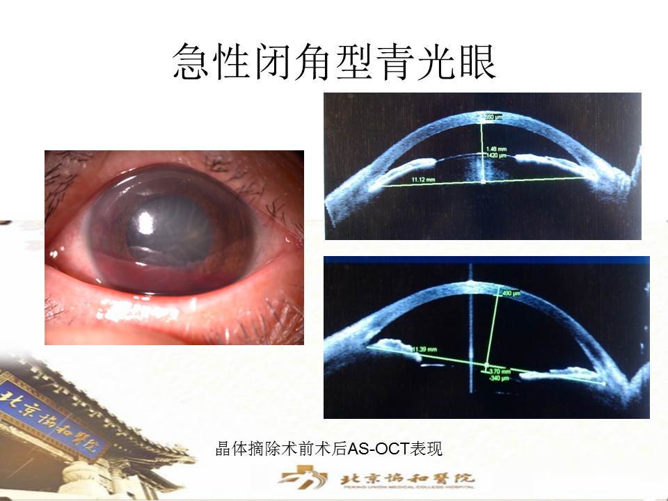 不同程度闭角型青光眼的治疗方案及效果 - 微医(挂号网)
