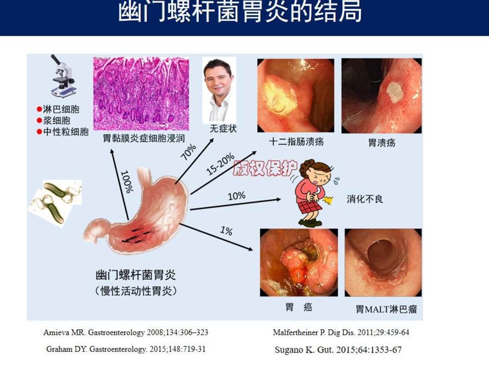 幽门螺杆菌感染会导致哪些疾病?_何必立医生文章_浙江省台州医院-微医