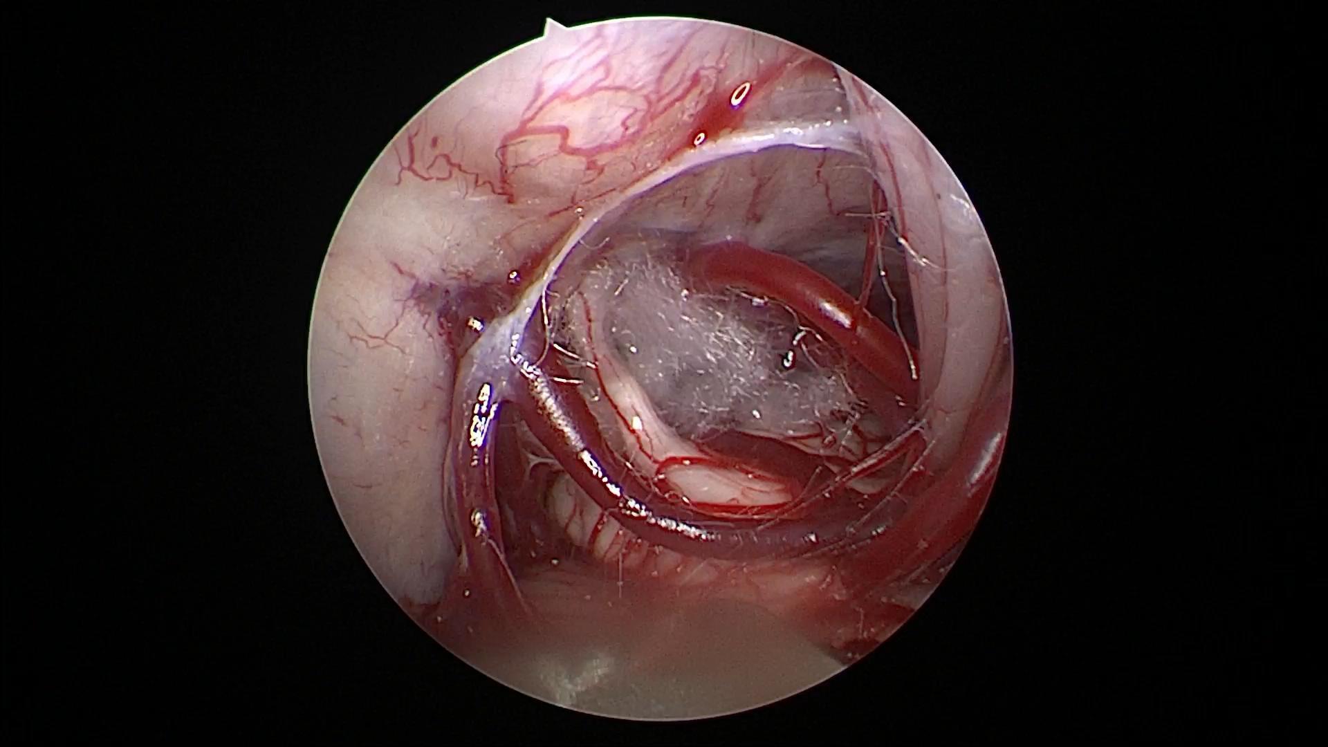 神经内镜下的三叉神经痛微血管减压术天下第一痛的终结