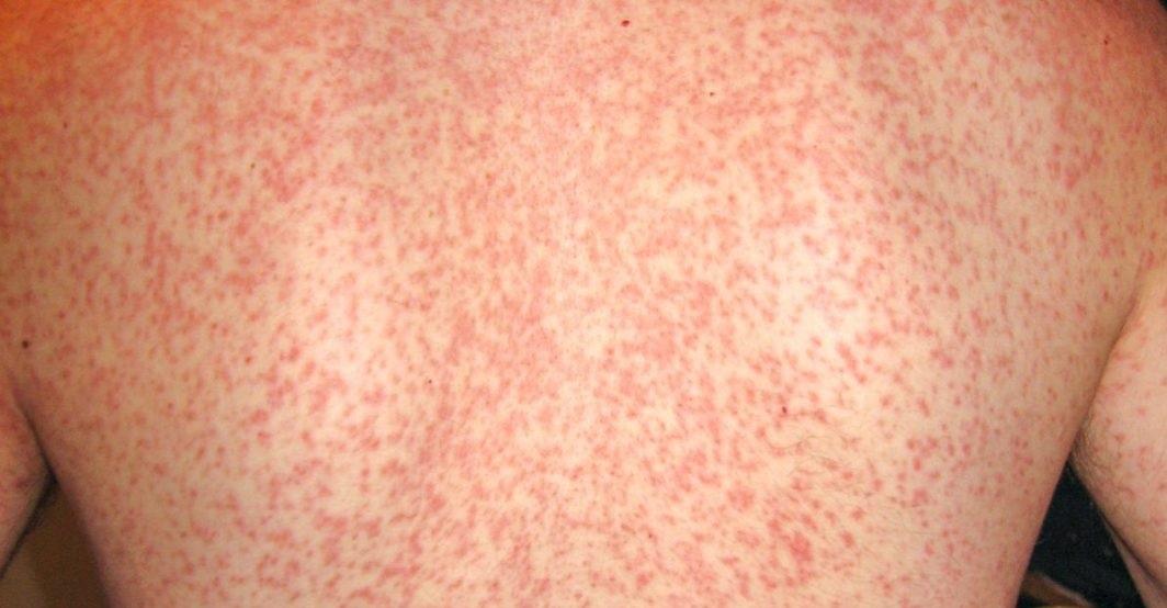 单核细胞增多症病毒疹是指病毒感染后全身或局部皮肤出现的皮疹,其