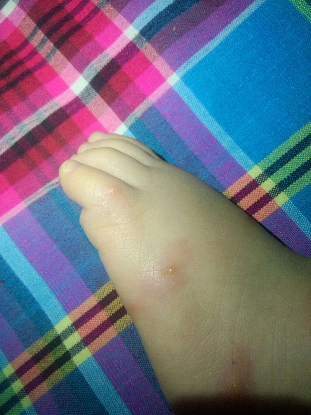 虫咬皮炎丘疹性荨麻疹为什么儿童那么多