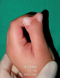 下面的ii型有存在桡侧指关节粘连,术前孩子手指关节是不能活动的,但我
