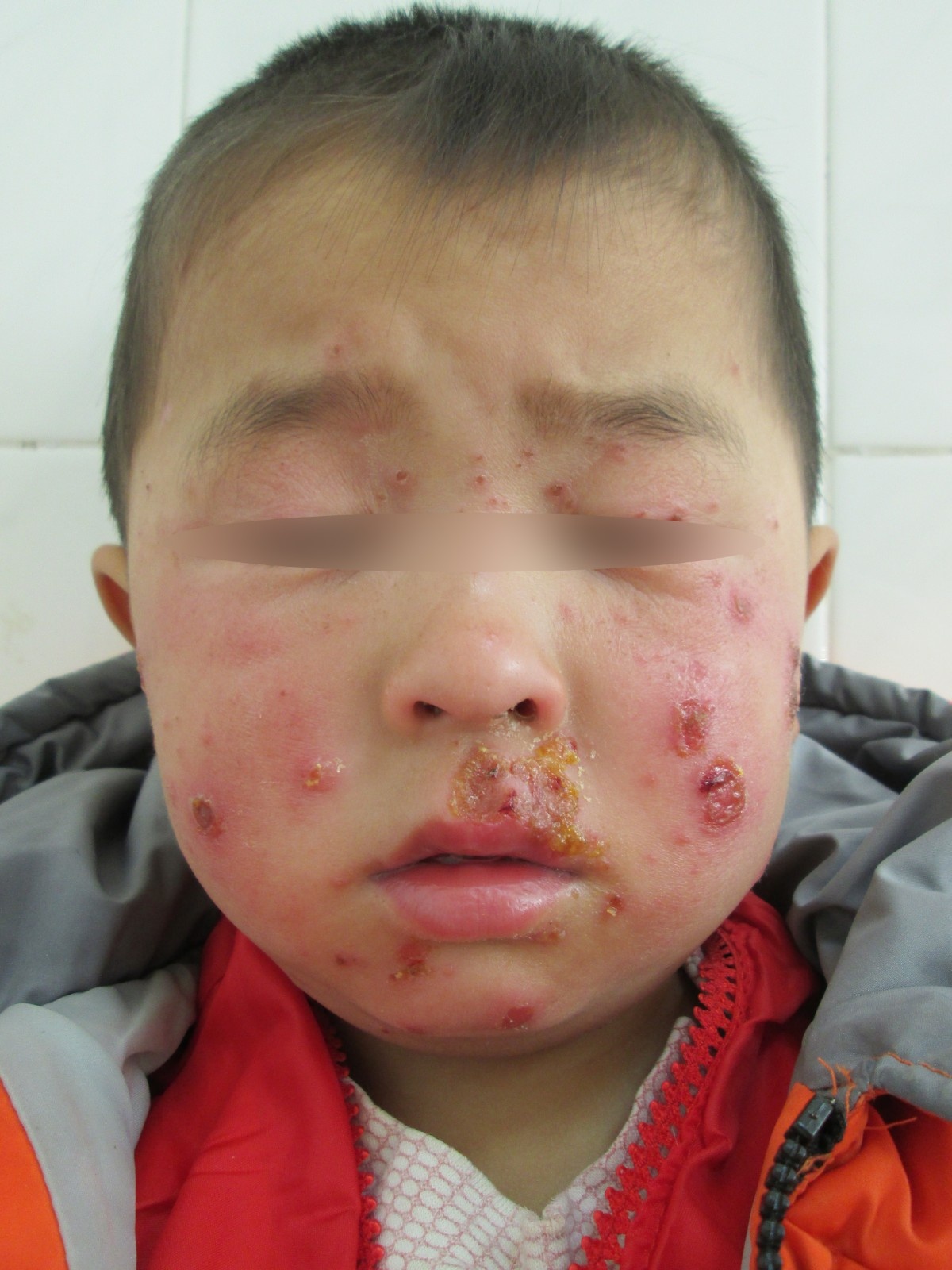 脓疱疮(黄水疮)诊断治疗