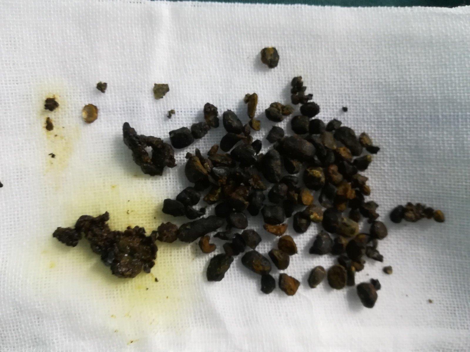 得了肝内胆管结石能不能通过微创手术取结石