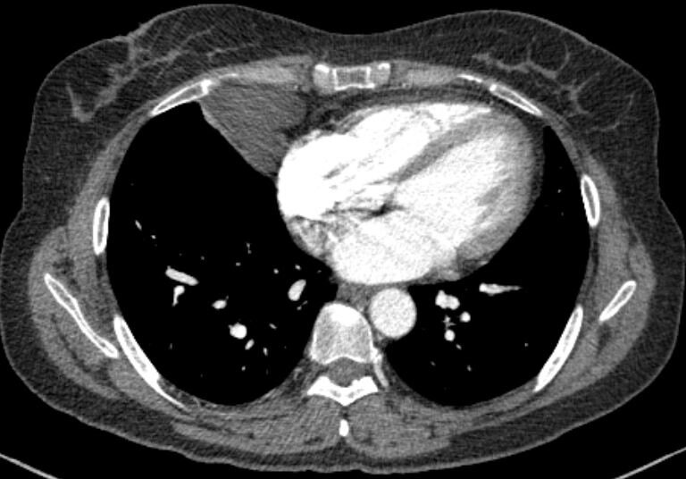 纵隔肿瘤是什么病?严重吗?