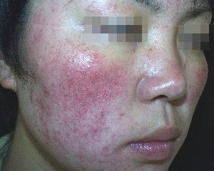 春天来了,专家教你如何防治皮肤过敏!