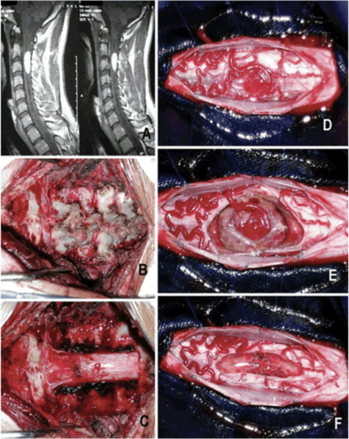 血管母细胞瘤2022版_魏社鹏医生文章_上海市东医院-微医
