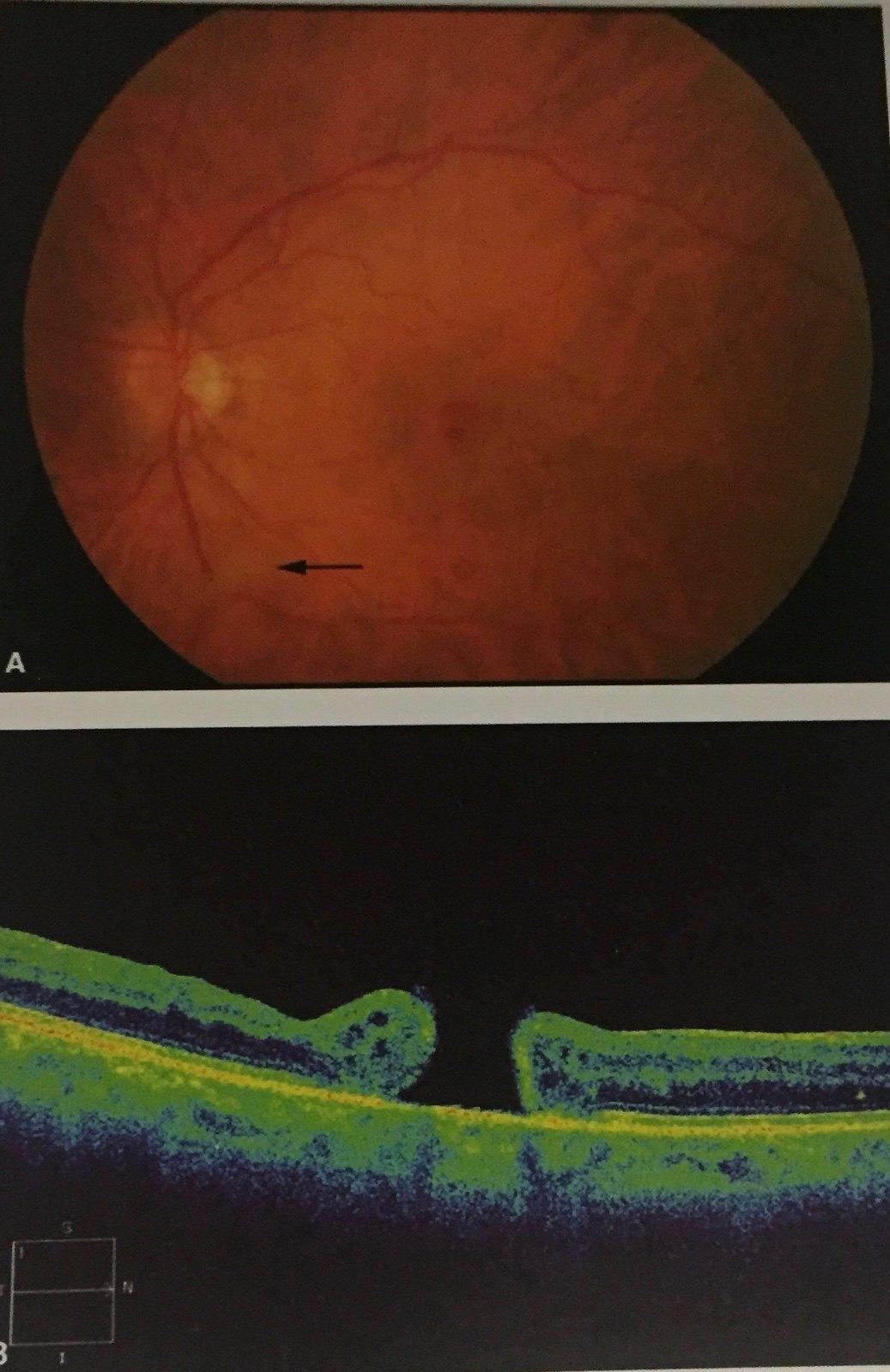 图3黄斑裂孔3期此时下图oct显示黄斑裂孔变大,边缘视网膜水肿变性,3期