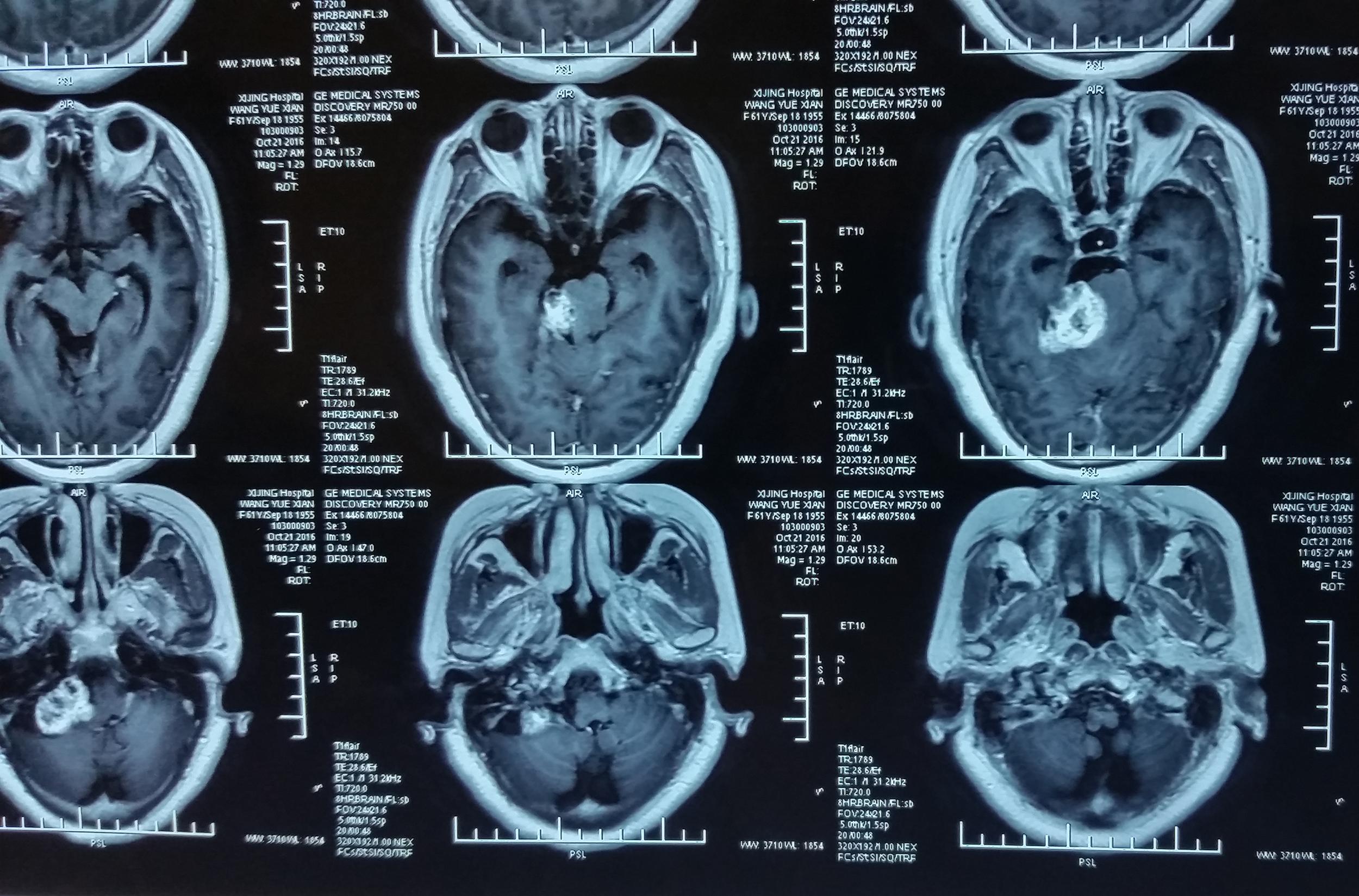 第一节 听神经瘤-神经疾病影像学图鉴-医学
