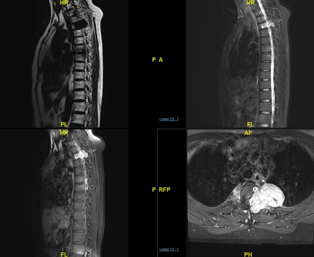 最近一个值得研究的病例:脊柱椎管内外沟通性神经鞘瘤1例 - 微医(挂号