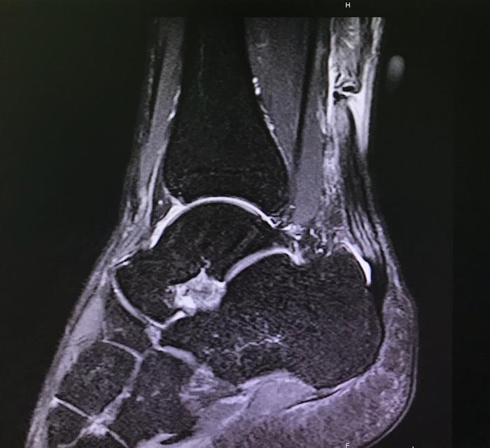 上海十院上海市首例微创跟腱断裂手术