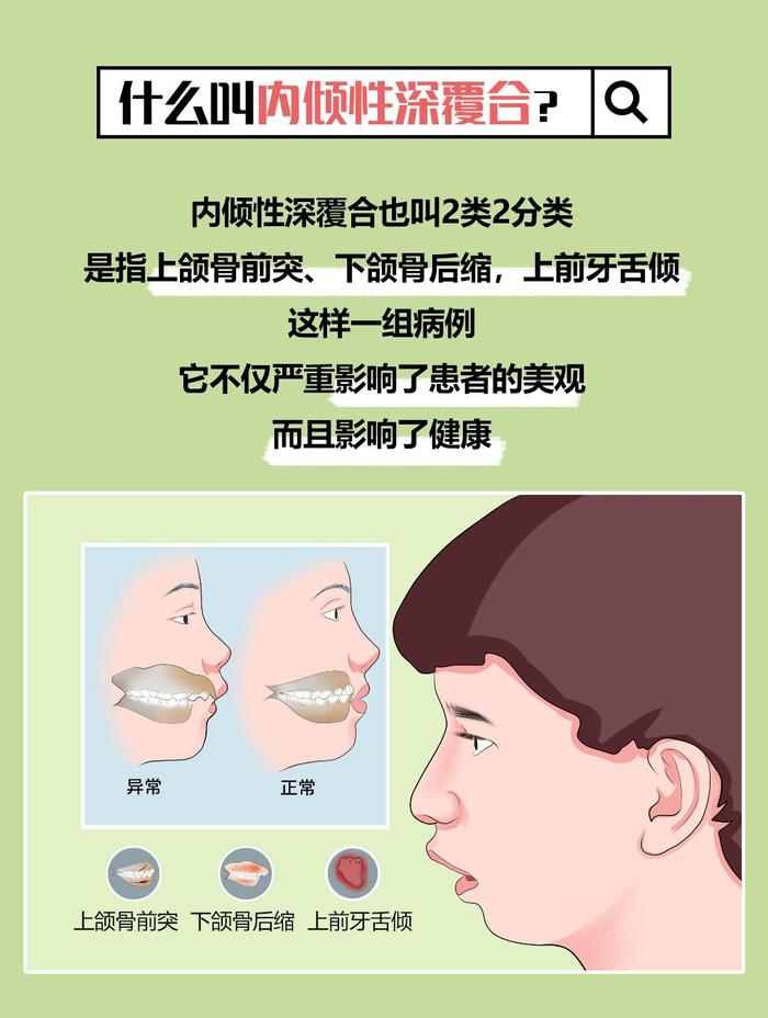 内倾性深覆合,是指上颌骨前突,下颌骨后缩,上前牙舌倾这样一组病例内