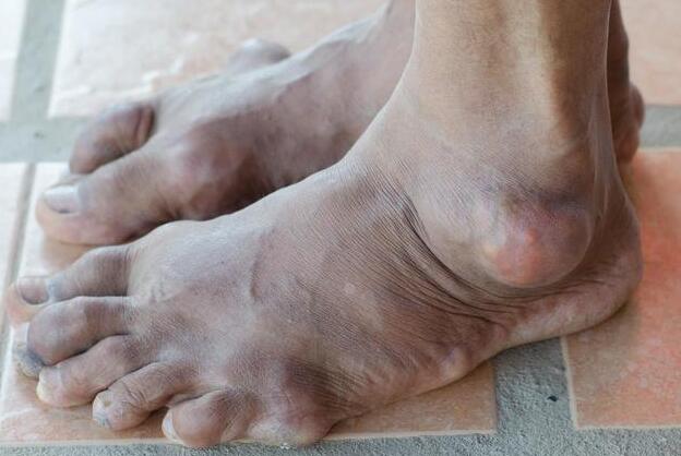 脚上出现3大症状痛风已上身一天然痛风药轻松止痛降尿酸