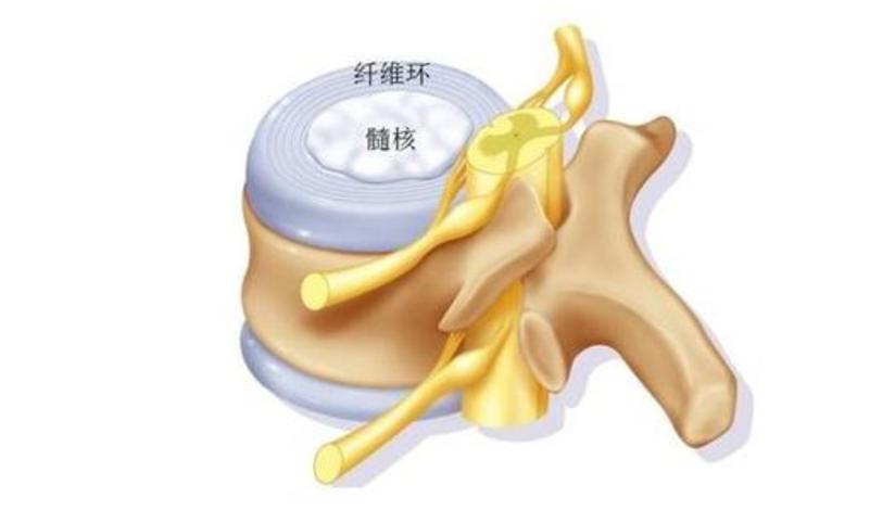 颈椎间盘突出症的症状有哪些 健康号 微医