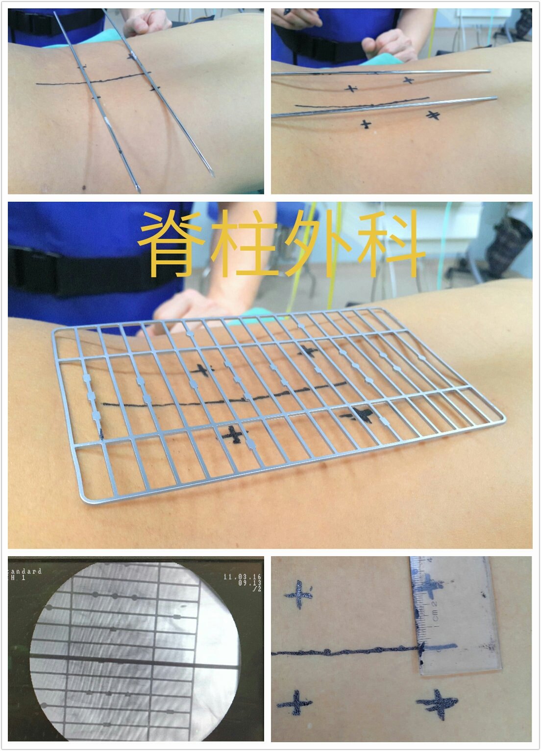 经皮置钉内固定术治疗胸腰椎爆裂性骨折病例分享