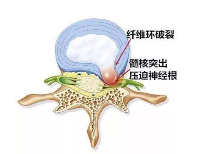 腰椎间盘突出,纤维环破裂还能否修复?