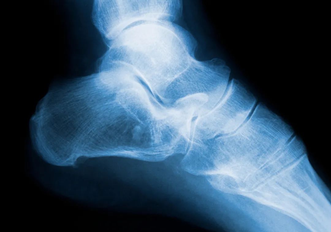 后脚跟疼!6个原因与5个缓解方法,统统在这里!-微医