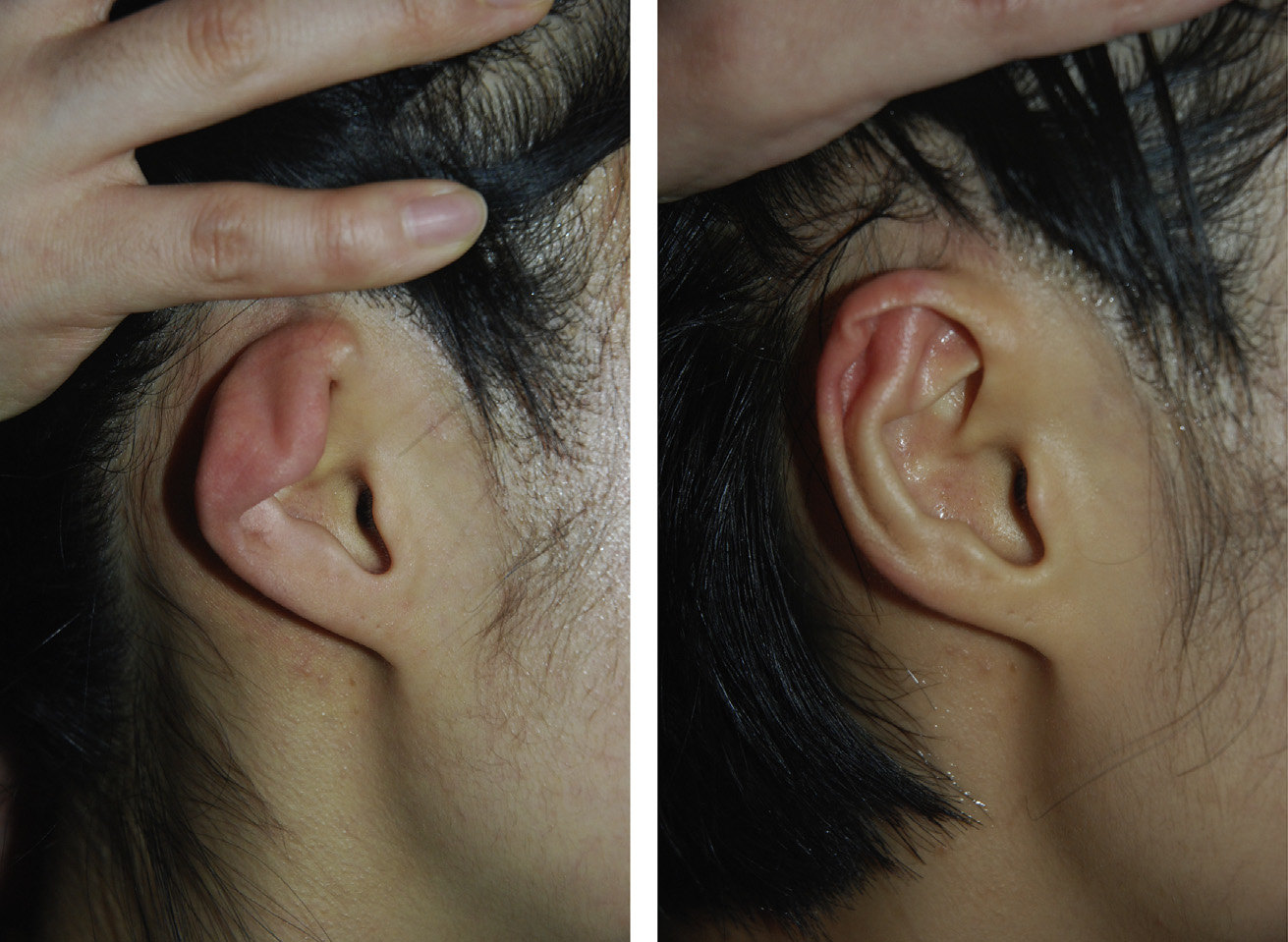 四字箴言读懂"杯状耳"整形手术全攻略(附案例效果多图).