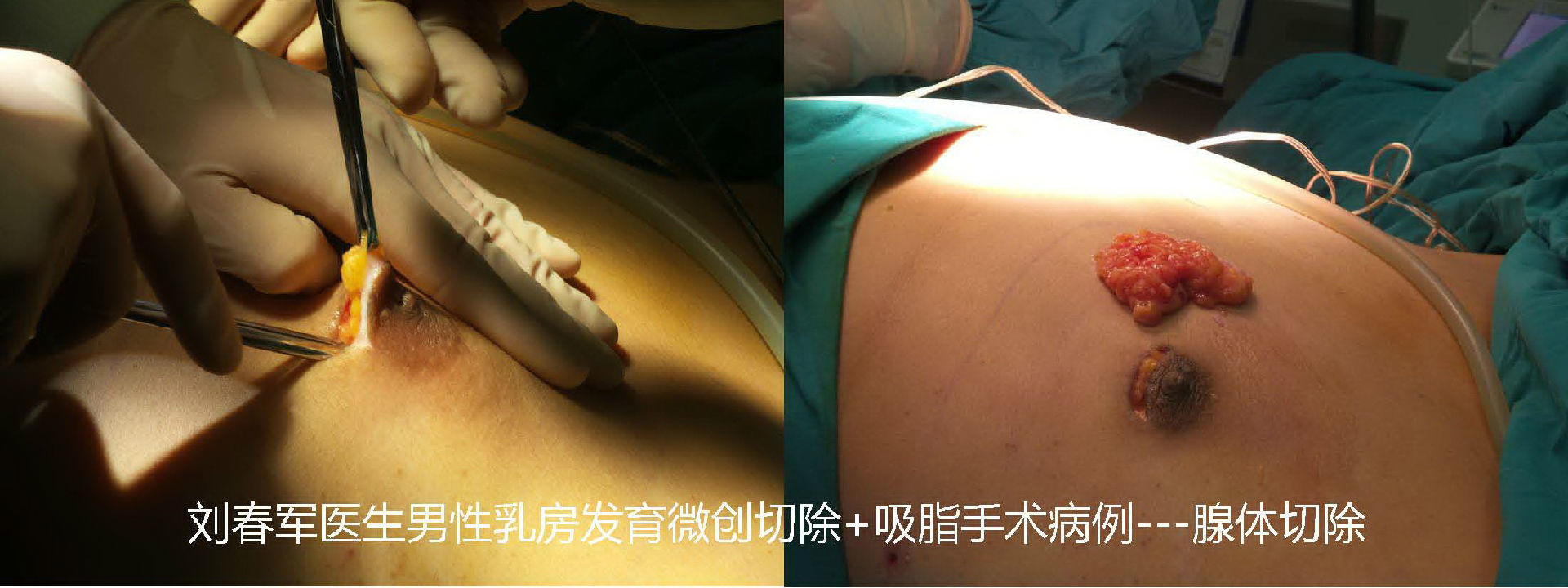 脂肪吸除后,在乳晕下半边缘做一个切口,在直视下分离并切除发育的乳房
