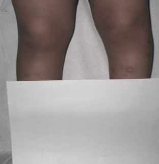 体格检查时,临床医生会寻找膝内翻(弯曲),屈曲和内旋畸形.