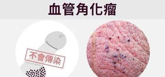 阴囊型血管角皮瘤会传染吗