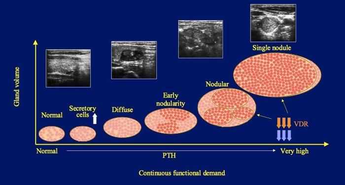 越不可逆转③医生的建议:基于手术控制pth的效果以及对未来肾移植术后