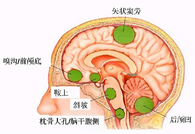 鼻炎or感冒闻不到味道别大意警惕这种脑膜瘤