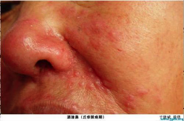 酒渣鼻玫瑰痤疮
