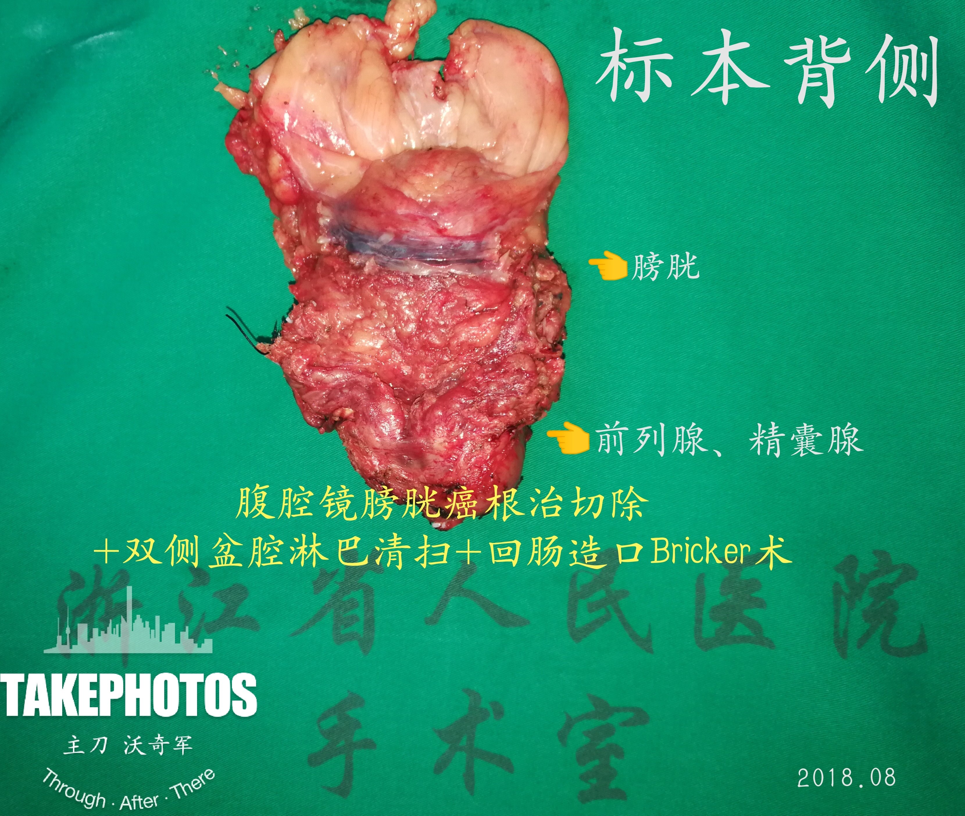 沃医生主刀手术7腹腔镜膀胱癌根治术