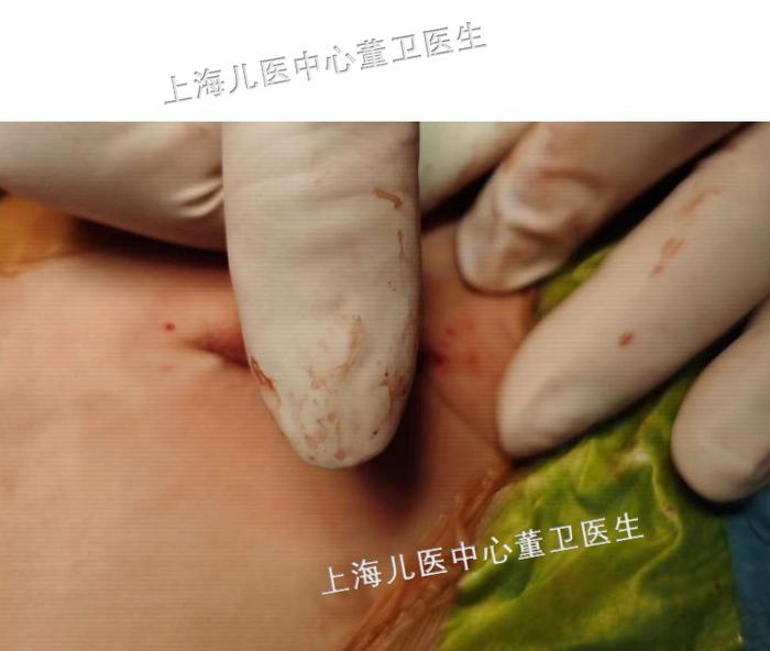 先天性心脏病室间隔缺损房间隔缺损与美容微创小切口手术