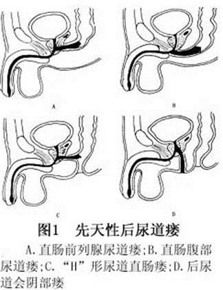 在正常尿道口排尿之外,可於尿道,会阴部,子宫,阴道等部位持续性滴状瘘