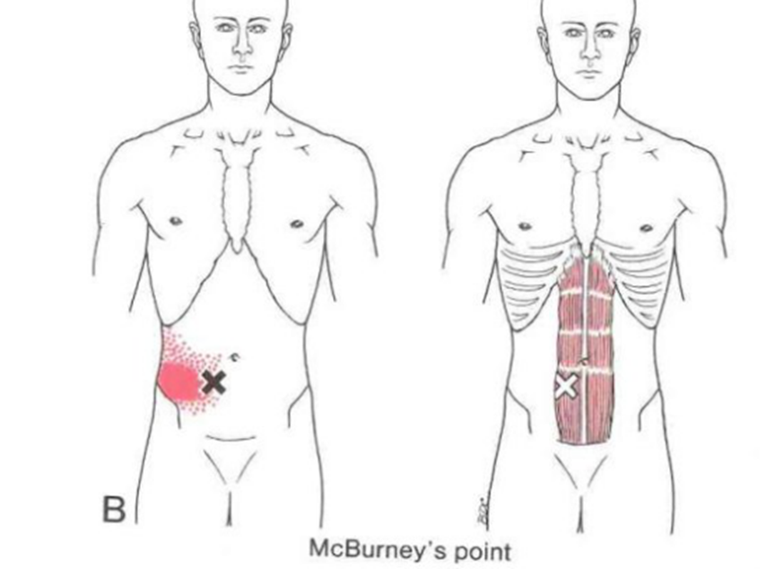 腹直肌怎么会引起腰背痛