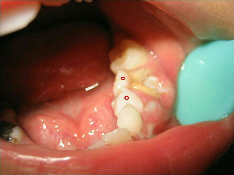 宝宝牙龈瘘管图片图片