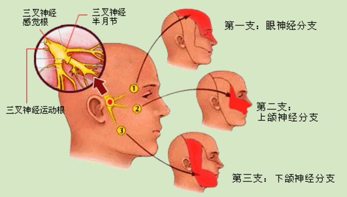 三叉神经痛被称为"天下第一痛",是一种在面部三叉神经分布区内,反复