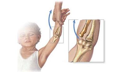 成语什么桡尺_桡尺关节在什么位置(3)