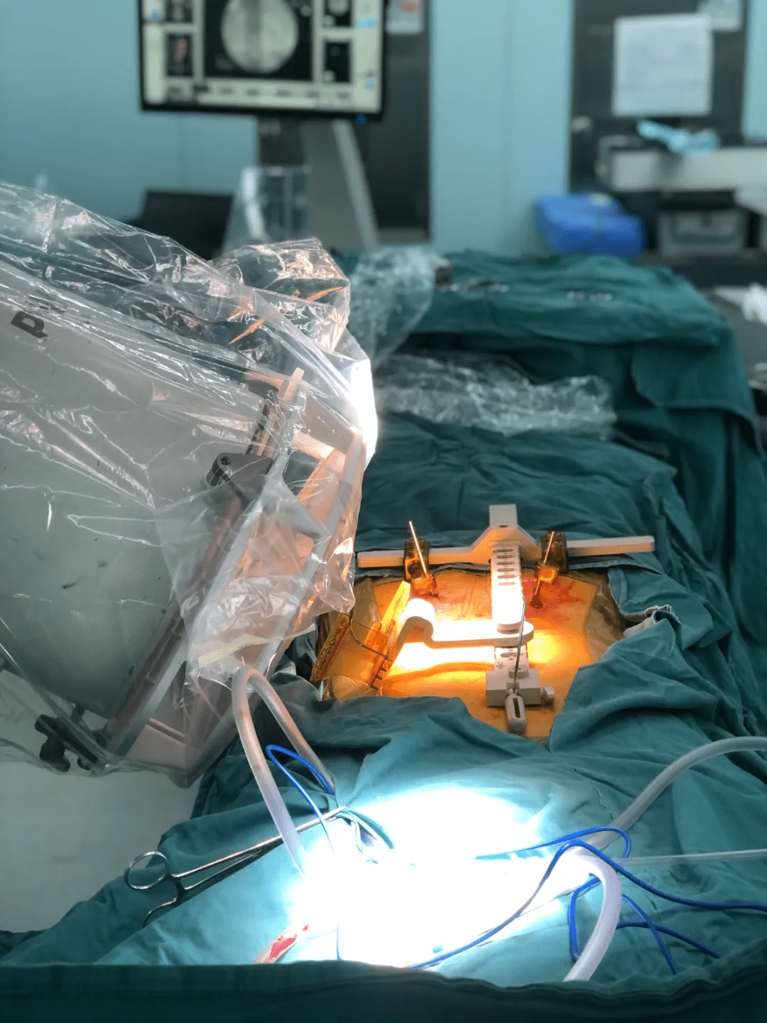 mazor脊柱机器人联合神经监测辅助治疗退变性脊柱侧弯