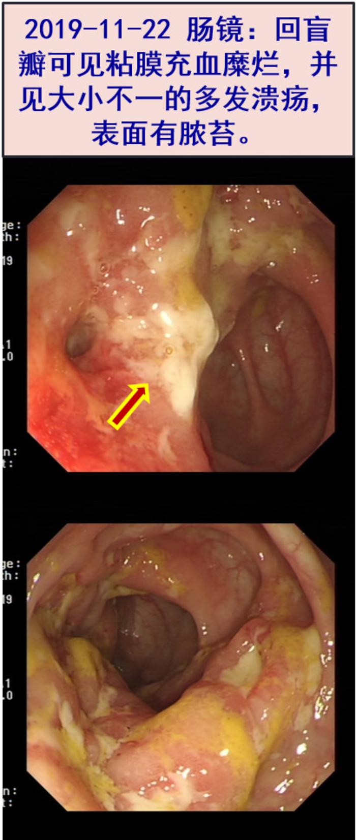 pet-ct:回盲部及周围淋巴结炎性病变可能;盆腔少量积液.