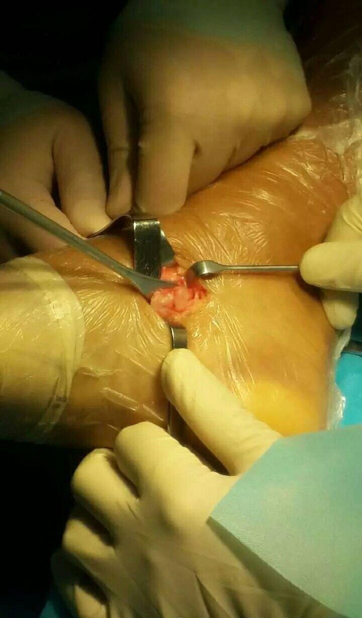 足内侧痛一副舟骨