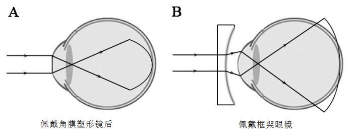 角膜塑形镜是怎样控制近视发展的