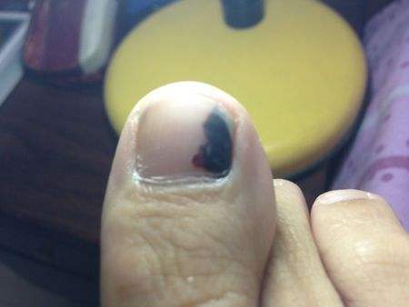 此外,还有一种常见的甲下变黑的病,叫甲母痣.