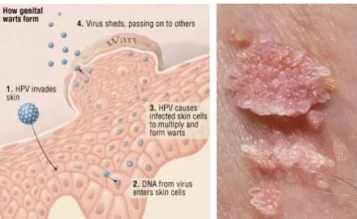 尖锐湿疣患者为什么要做hpv检测