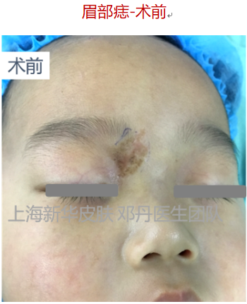 痣的案例,采用手术切除 局部皮瓣修复 减张 点阵激光疤痕修复的综合