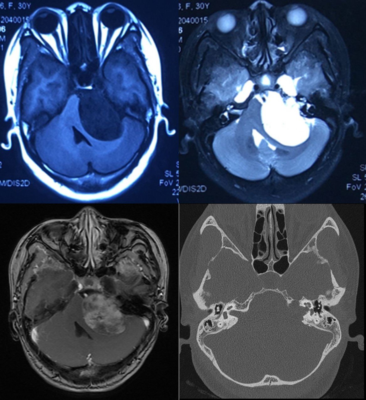 科普堂听神经瘤